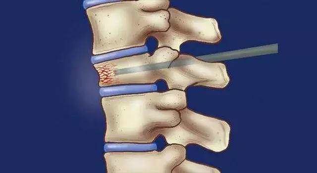 怎样治疗椎体压缩性骨折,打骨折怎么恢复