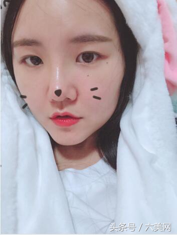 隆鼻后如何克服焦虑,隆鼻后前三天状态