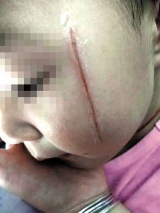 3岁女童被同学划破脸，幼儿园的做法，宝妈选择报警