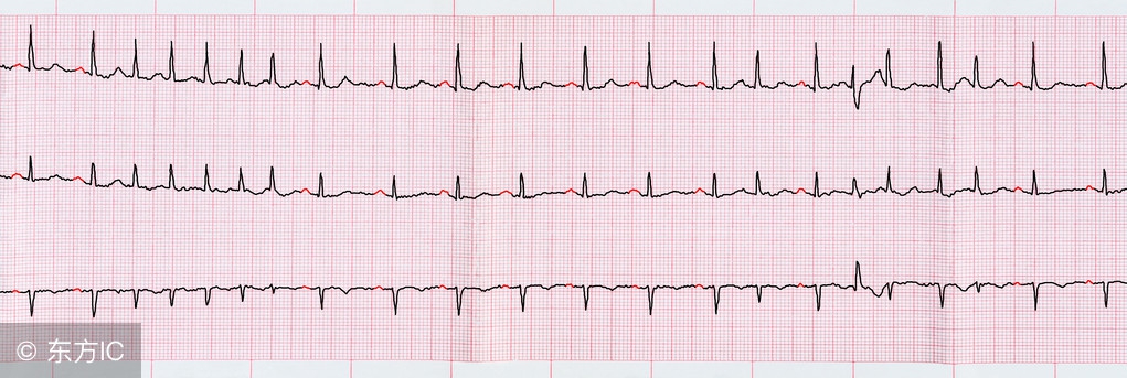 心律失常早搏到底如何预防,心脏早搏的原因及危害有哪些