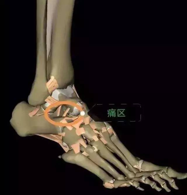 跗骨窦综合征影像诊断视频,跗骨窦损伤针灸治疗