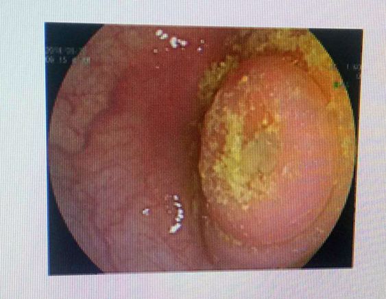 市县专家联动，淳安县中医院成功开展全县首例内镜下逆行阑尾炎治疗术（ERAT）