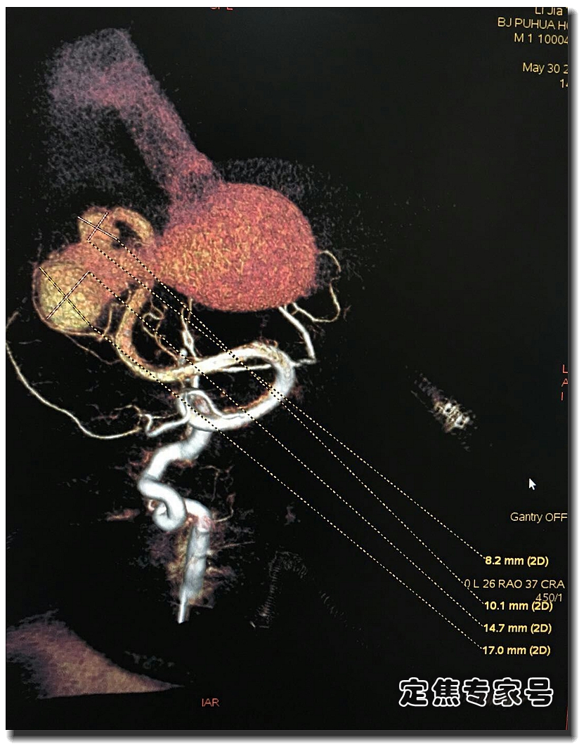 一岁男孩脑子里发现“小苹果”偷血，医生把“钢筋水泥”灌了进去