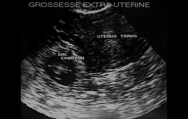 宫外孕患者需要注意的事项,宫外孕的9种病因必须高度警惕
