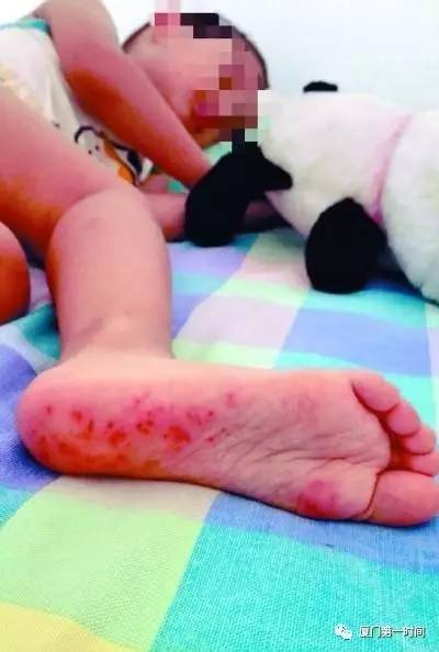 「疫情预警！」警惕！这种儿童传染病正高发！福建家长注意！