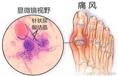 痛风减肥尿酸会高吗,减肥可以治痛风降尿酸吗