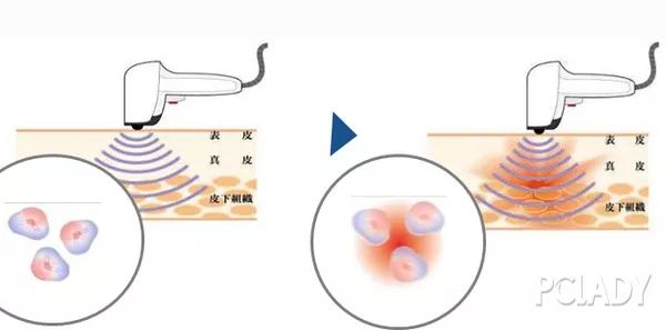 如何解决掉显老又讨厌的法令纹,法令纹不用愁一招帮你改善