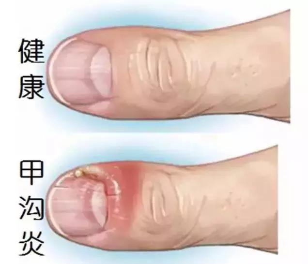 跑步跑到脚趾甲盖里面有水泡图片,跑步脚上出现黑趾甲该怎么处理