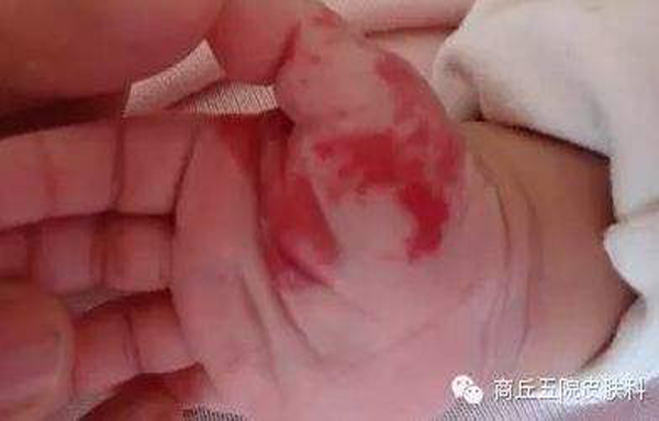 从头到脚了解婴儿第三章葡萄酒斑