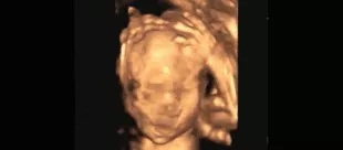 为什么我的彩超看不清宝宝,为什么我的四维彩超看不见脑门