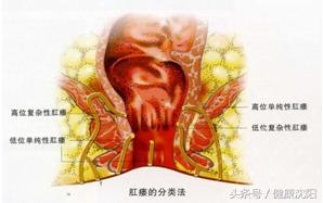 科普肛瘘为什么不能自愈,肛瘘引流科普视频