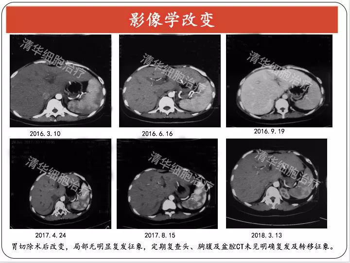 鑳冪檶nkt鍏嶇柅娌荤枟鎴愬姛妗堜緥,鑳冪檶nk鐤楁硶