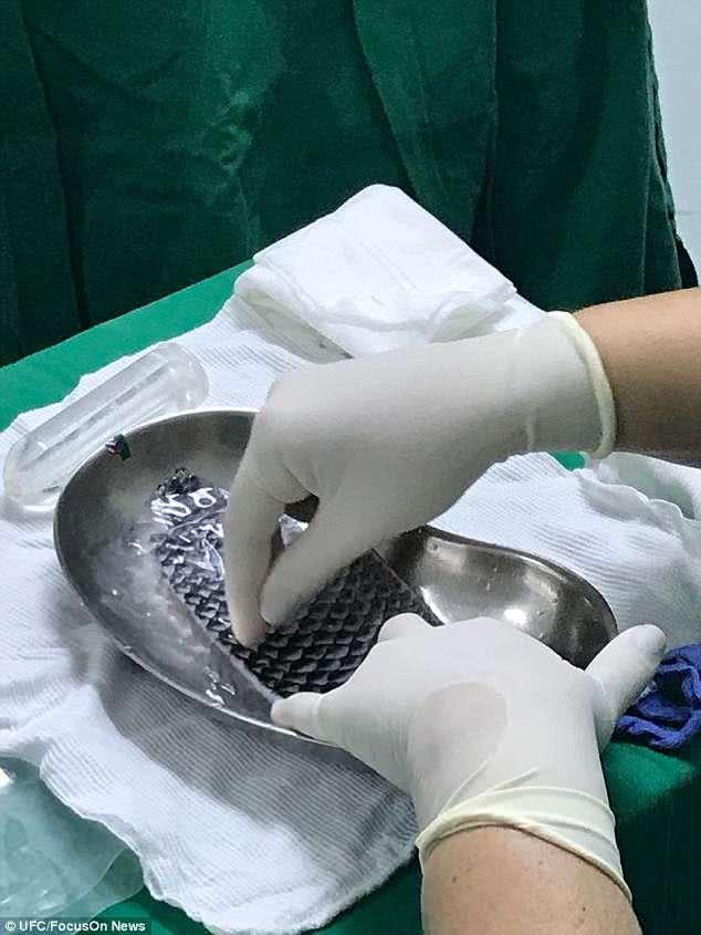 先天阴道缺失她成为首个体验鱼皮重塑阴道手术的女大学生