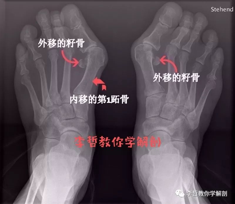 拇外翻该怎么办,拇外翻的解决方法