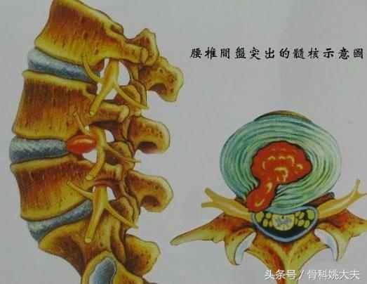 怎么爬行治疗腰间盘膨出,牵引对腰间盘膨出有效吗