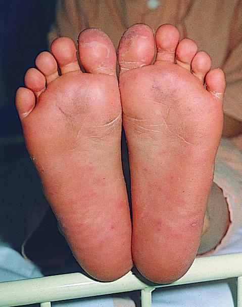 中医治疗手足口病最佳方法,中医辨证手足口病