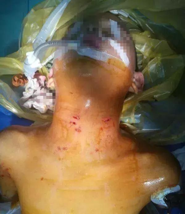 6岁男童被自家狗咬得遍体鳞伤,男童被狗咬伤18天后身亡