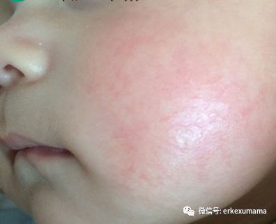 小孩脸上有一个红点带血丝,小孩脸上有颗红痣还有血丝