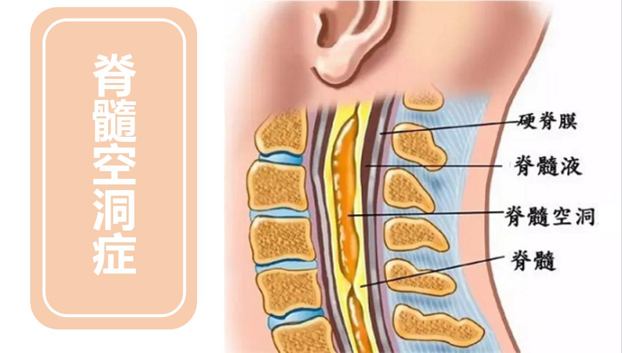 脊髓空洞症手术后还能正常上班吗,脊髓空洞会引起哪些并发症
