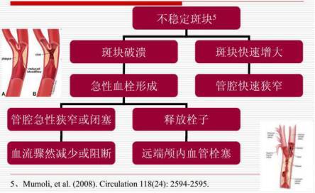 识别易损斑块方法,从了解到熟练五个阶段