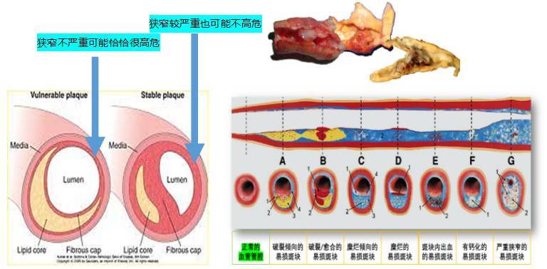 识别易损斑块方法,从了解到熟练五个阶段