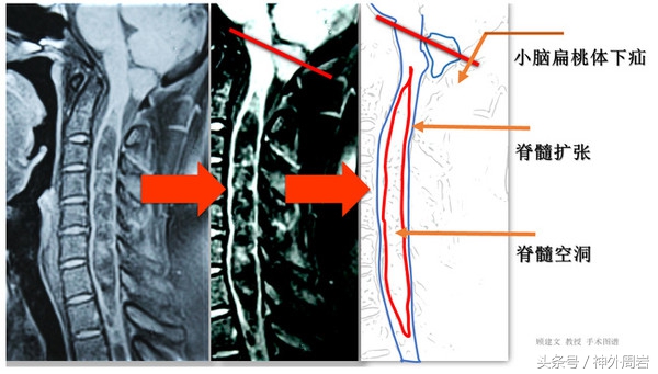 chiari鐣稿舰,chiari鐣稿舰纭瘖