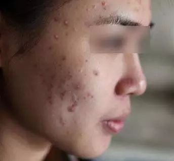 央视曝光27款让人烂脸的面膜,国货医美面膜黑榜