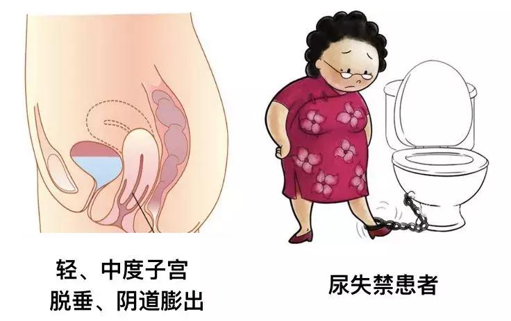 给力视界,世界尿失禁周专题讲解