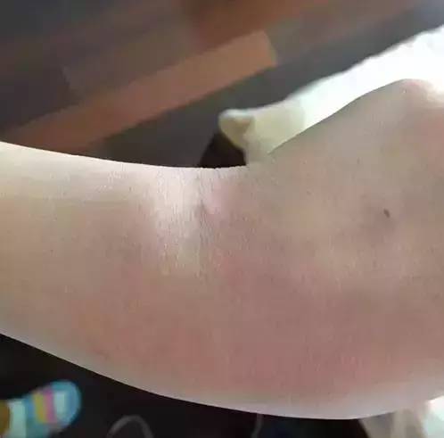 鉴别疱疹性咽峡炎和手足口病,疱疹性咽峡炎转成手足口了怎么办