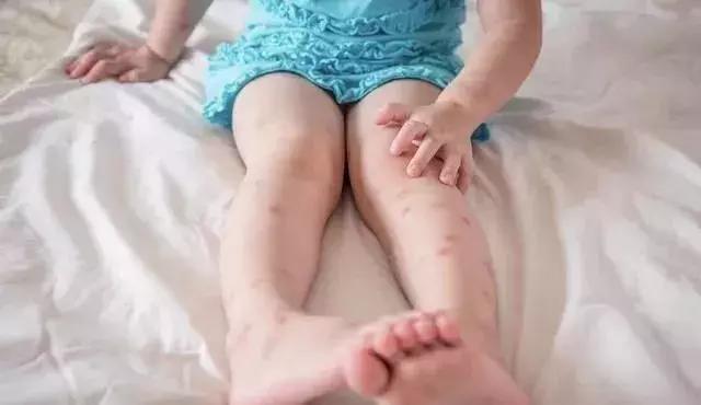 宝宝被蚊虫叮咬的疙瘩一直不消除,宝宝被蚊子叮咬的红包怎么消肿