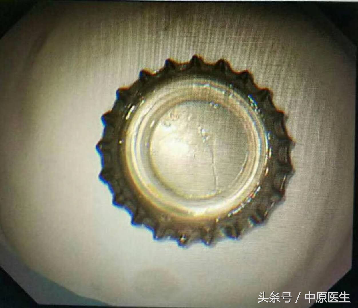 让人脑洞大开的“套套”用法：专家把男子喝到胃里的啤酒盖取出