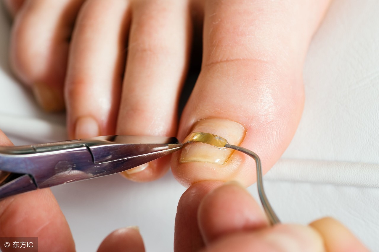 简述灰指甲的成因表现和处理方法,灰指甲形成原理示意图