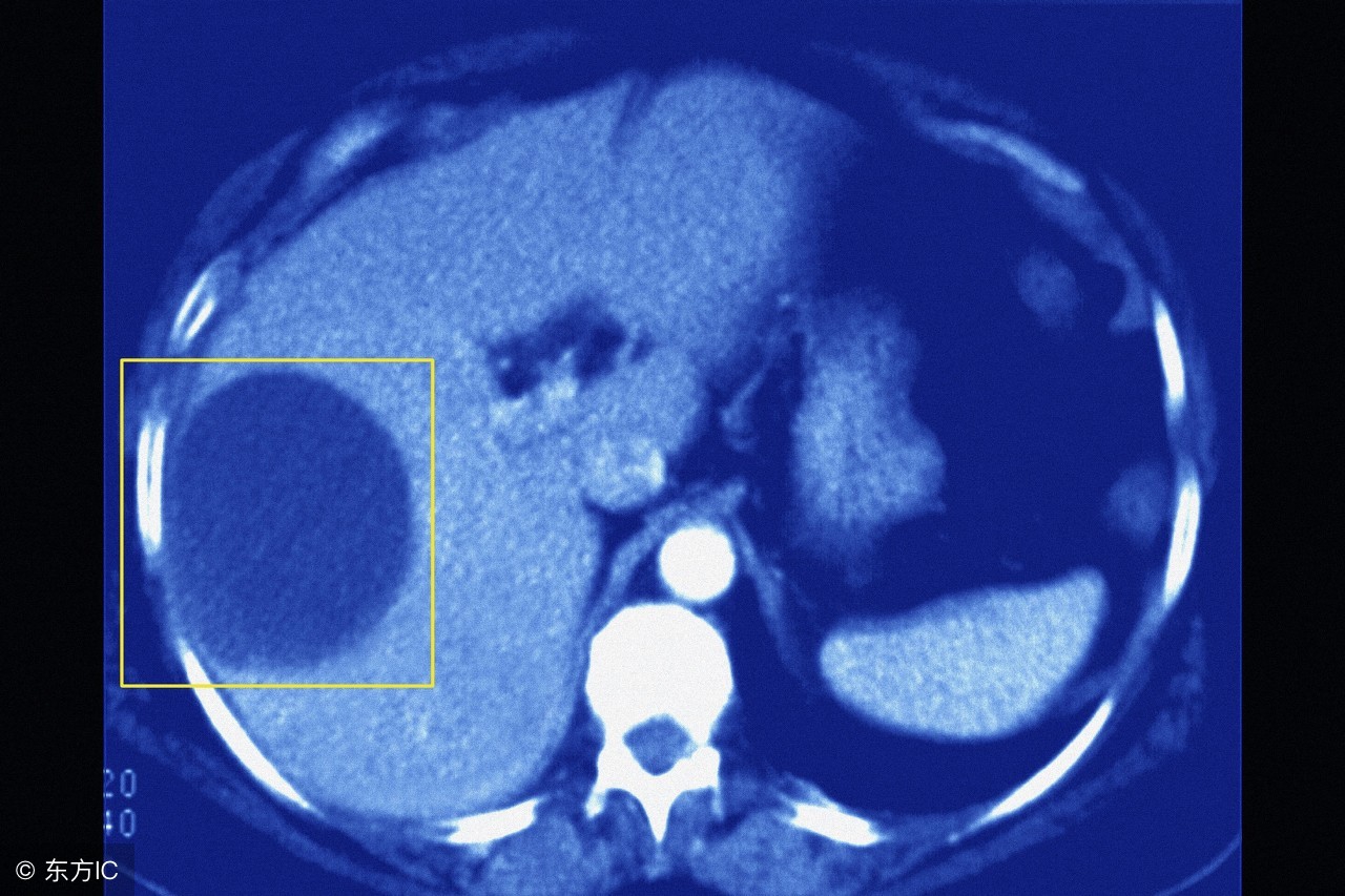 囊肿是肿瘤吗囊肿和肿瘤谁严重些,如何区分卵巢囊肿是囊肿还是肿瘤