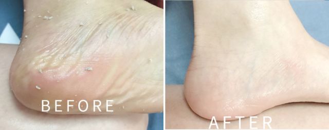 擦掉一张皮，双脚换皮术！死皮、老茧一喷就没，15秒还原嫩白玉足