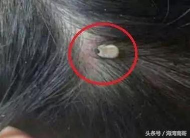 牛被蜱虫咬后怎么治疗,很小的牛蜱虫咬人拔了之后怎么办