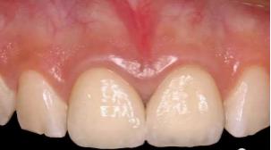 怎么拯救牙齿最快最有效,如何拯救牙齿