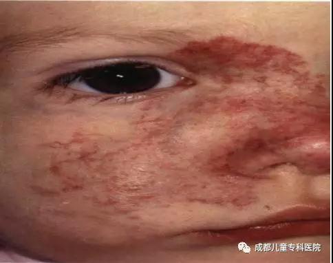 后脑勺红色印记是胎记还是血管瘤,皮肤有红色印记是血管瘤还是胎记