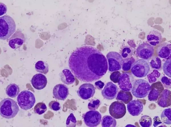 印度白血病新药,印度仿制白血病特效药