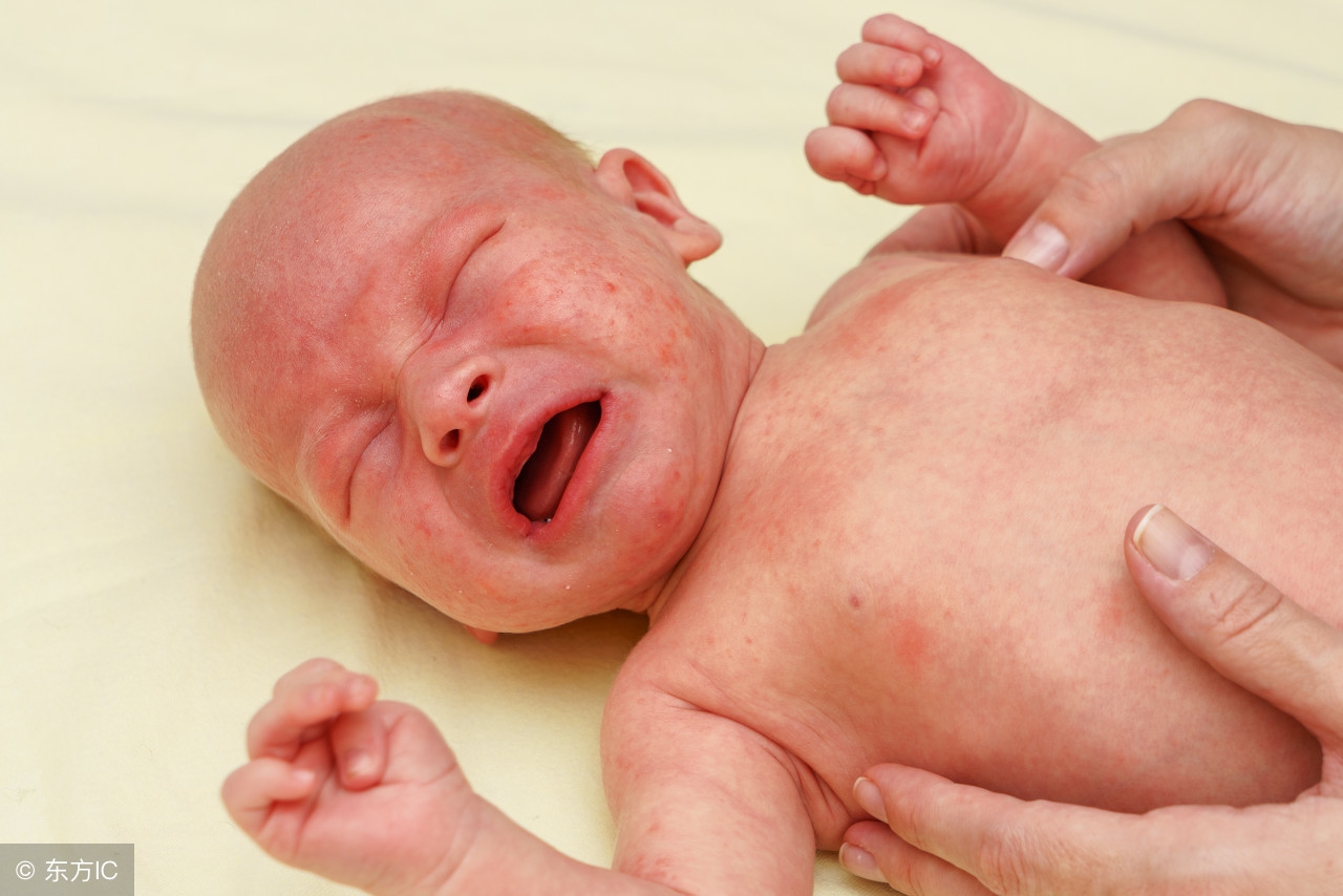 这个季节常见儿童皮肤病,芬母治疗婴儿湿疹冒水效果怎样
