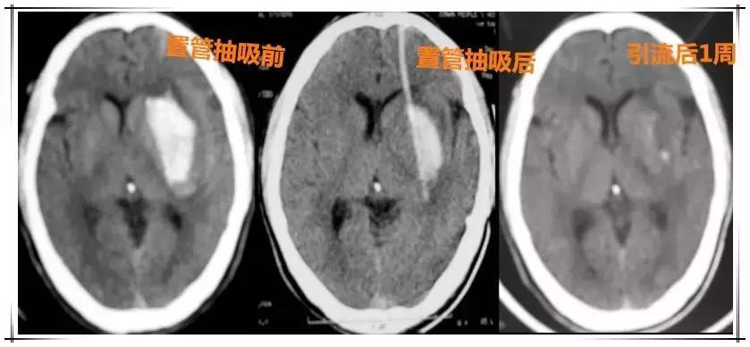 脑出血半年多了脑壳晕能治愈吗,查出脑出血手术打开脑壳很严重吗