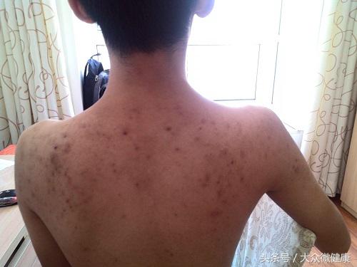 背上长痘的解决办法,背上长痘的原因和治疗方法