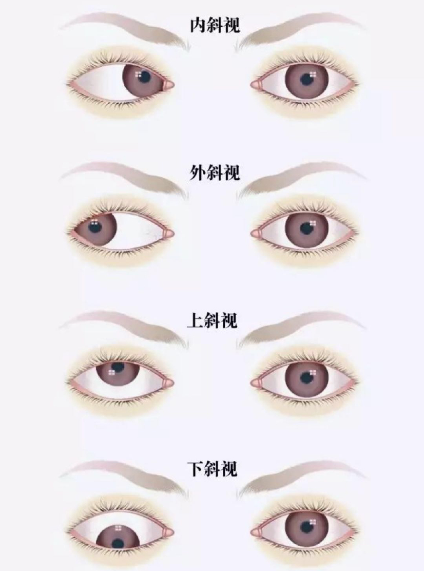 孩子有时候斗鸡眼怎么纠正,孩子有轻微斗鸡眼如何矫正