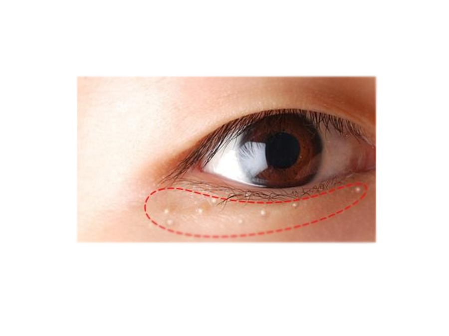 洗鼻子洗出白色絮状粘稠分泌物,鼻子上的白色分泌物用什么药