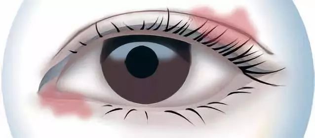眼睛患结膜炎红肿发痒，别乱滴眼药水