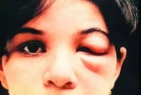 潍坊所有的家长，这种虫子传播新型艾滋病，最喜欢叮咬孩子……