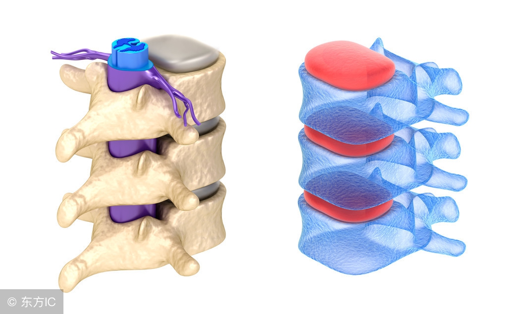 腰间盘膨出、突出、脱出有什么不同？骨科医生靠它来区分！
