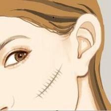 邯郸治疗疤痕疙瘩,河北邯郸疤痕疙瘩最好治疗方法