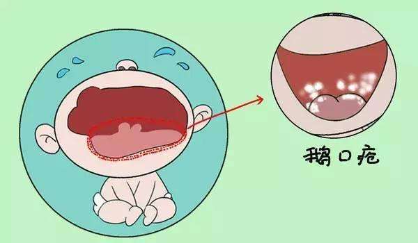 新生儿鹅口疮怎么预防和处理,新生儿鹅口疮引起的原因是什么