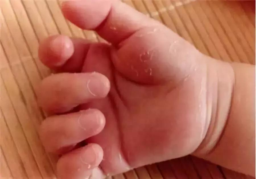 小孩汗疱疹脱皮怎么治疗,孩子手脱皮汗疱疹怎么解决