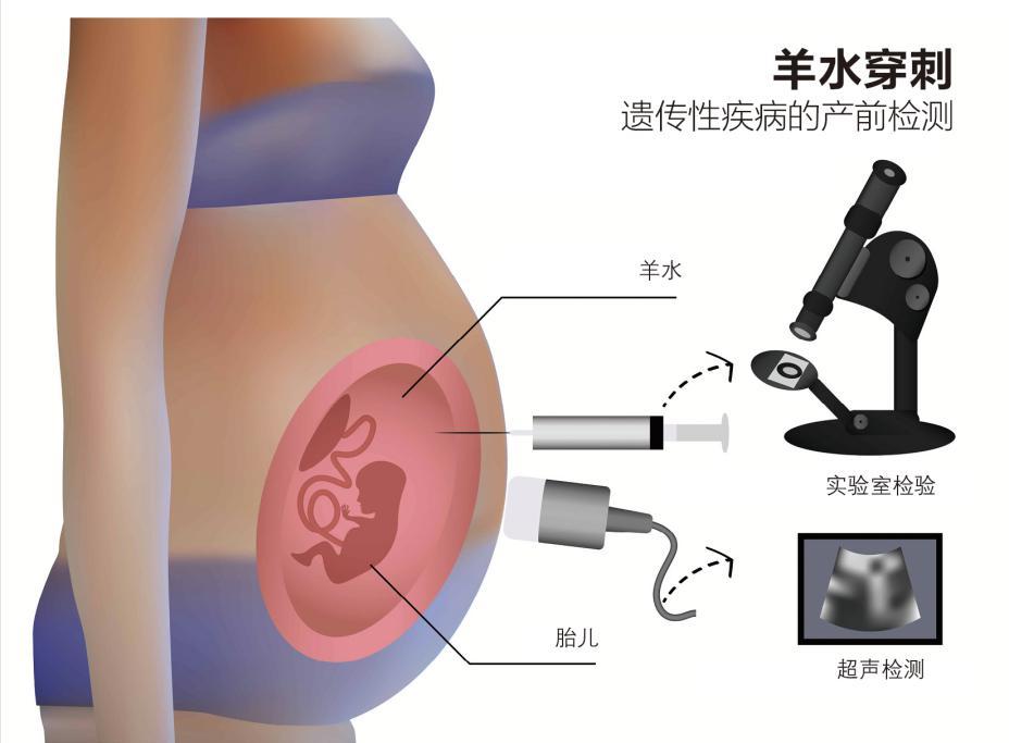 羊水穿刺太可怕所以去做无创DNA检测?协和妇产专家谈羊穿恐惧症